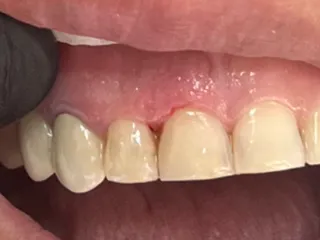 Result of a composite restoration on a front tooth, natural look and shine