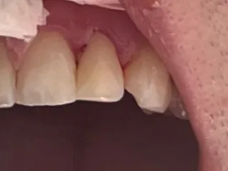 Restored tooth edge with a composite veneer, result after the procedure